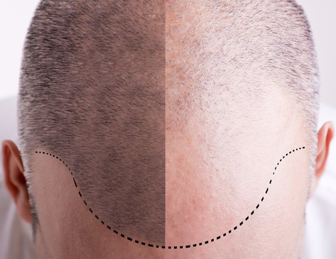 Slider image (4) CAPMED (Hair Transplant and Aesthetic Medicine)